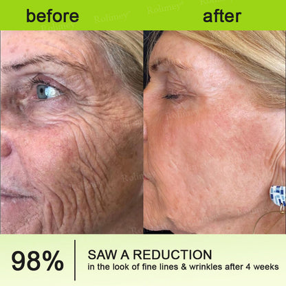 Rolimey® Botox & Vita-A Retinol Shot Wrinkle-Lift Tightening cream - Last Day Promotion 70% OFF